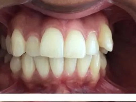 Before: Case 4: Smile restoration