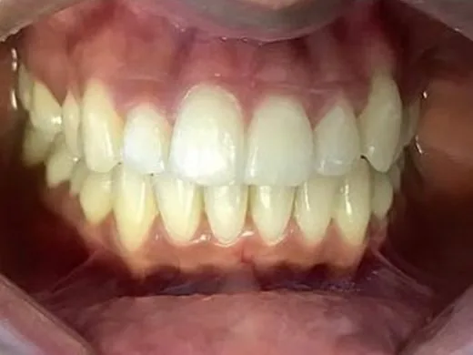 After: Case 4: Smile restoration