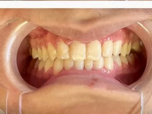 After: Case 1: Alignment & cosmetic finish