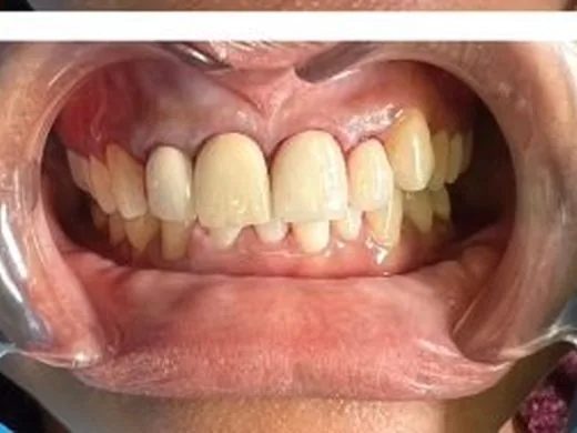 After: Case 2: Realignment without braces