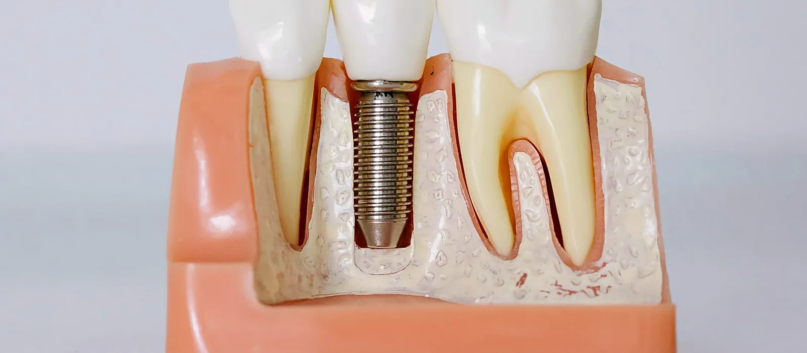 Dental Implants at Bright Smiles - Savoy Dental Centre