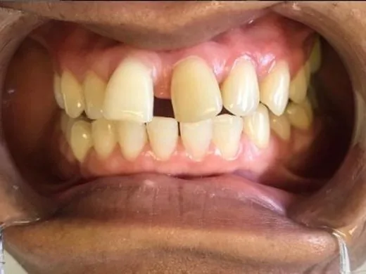 Before: Case 3: Gap closure & restoration