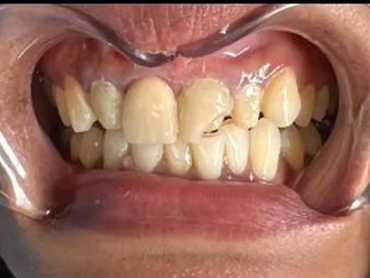 Before: Case 2: Realignment without braces