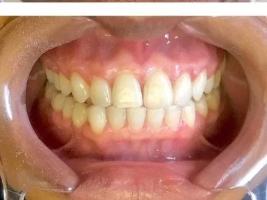 After: Case 3: Gap closure & restoration