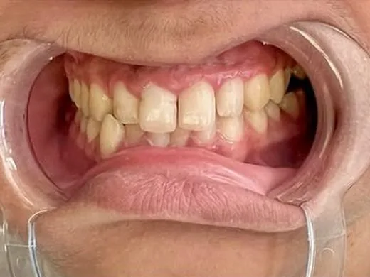 Before: Case 1: Alignment & cosmetic finish